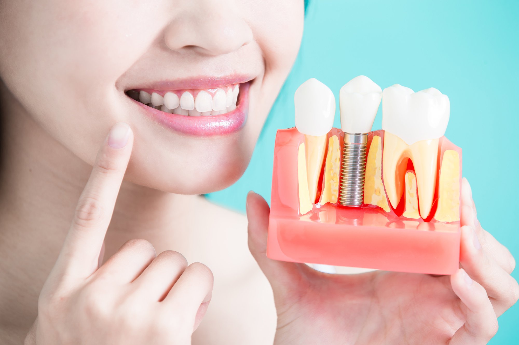 Dental Implants Decoded: Your Guide to a Confident Smile