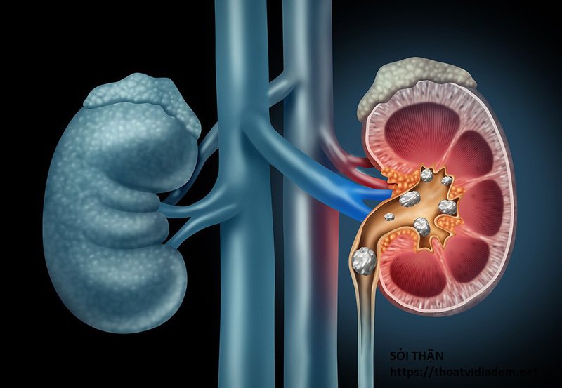 renal colic