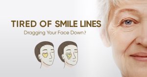 Smile Line Treatment